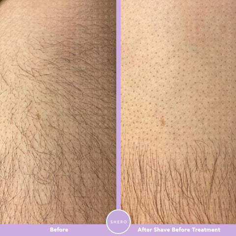 IPL Hair Removal Results For Men Before and After Shaving