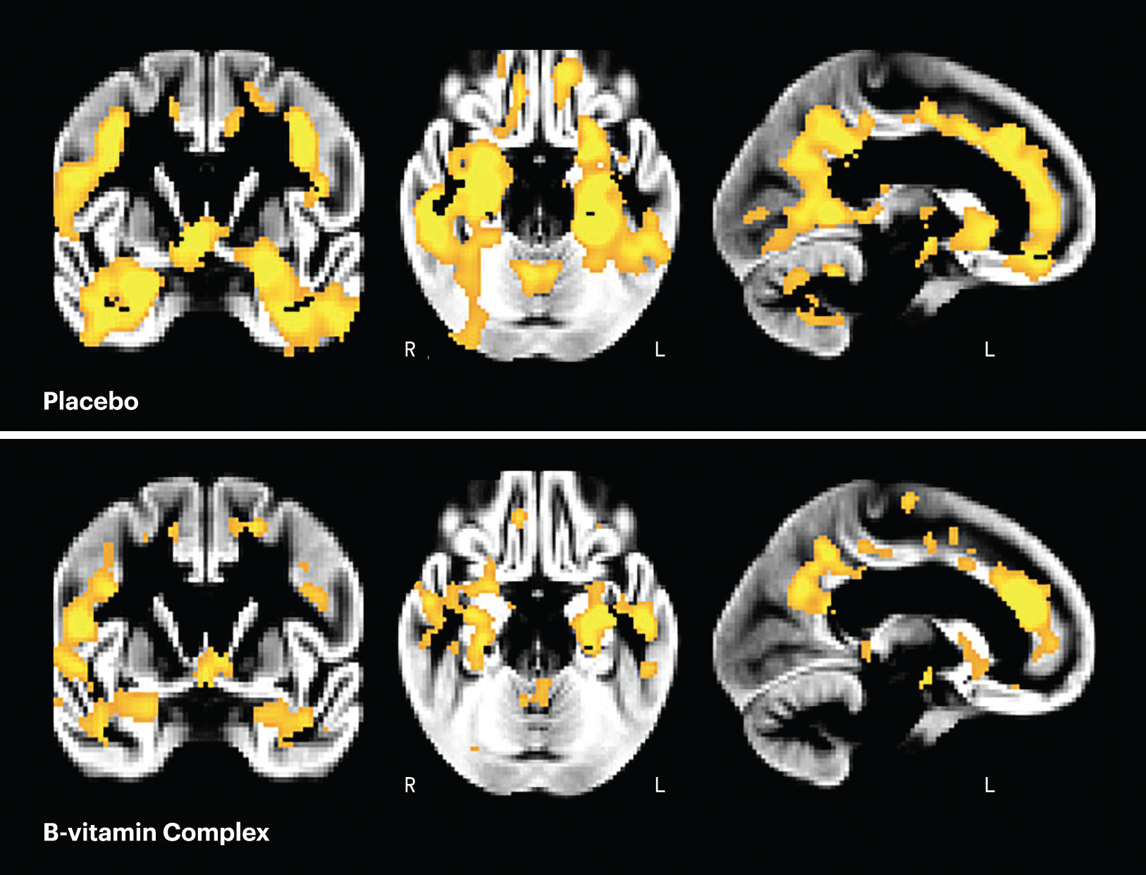 Regions of brain atrophy in placebo versus b-vitamin treatment