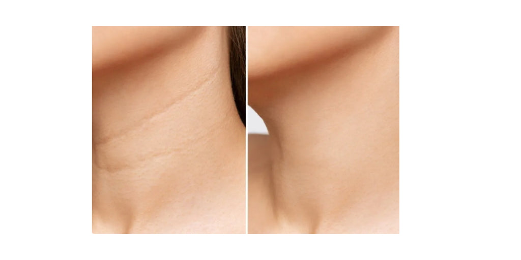 neck with wrinkles and lines before using firming neck and throat creme and after