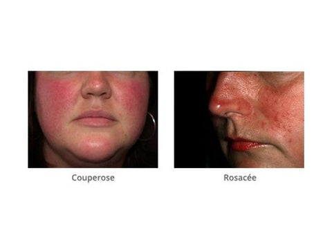 HOW TO TREAT ROSACEA : SKINS CASE STUDY