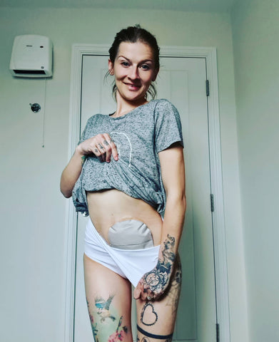 Amy Ostomy Feature 1