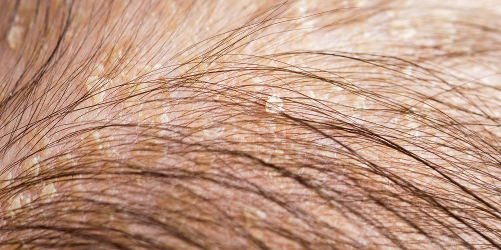 Close up image of flakes on an irritated scalp