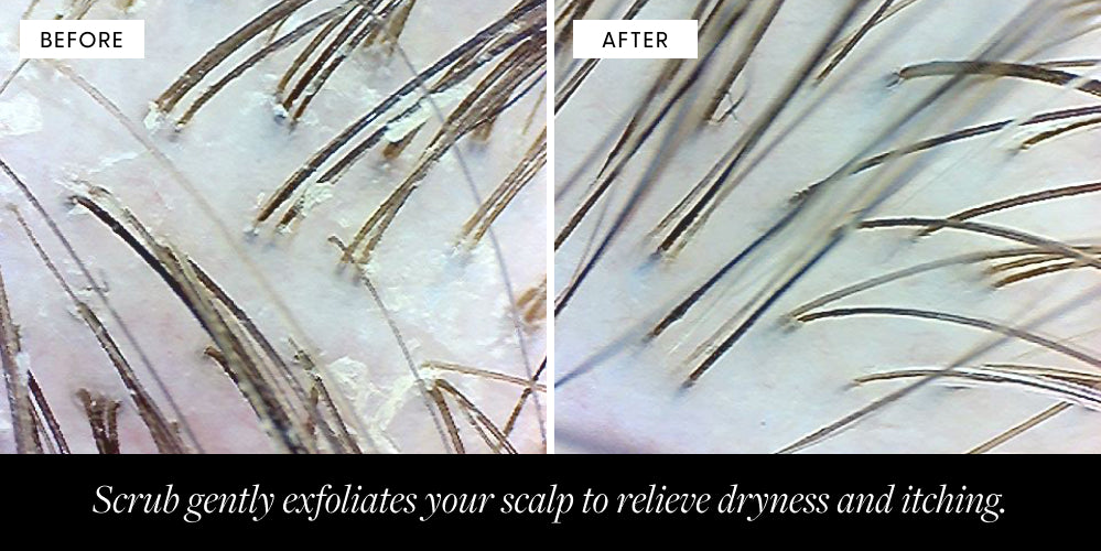 Before and After Scalp image when using Scrub Exfoliant