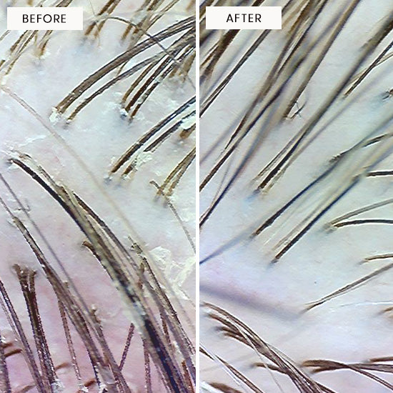 Before and after images of a scalp that has been exfoliated with Arey scalp scrub