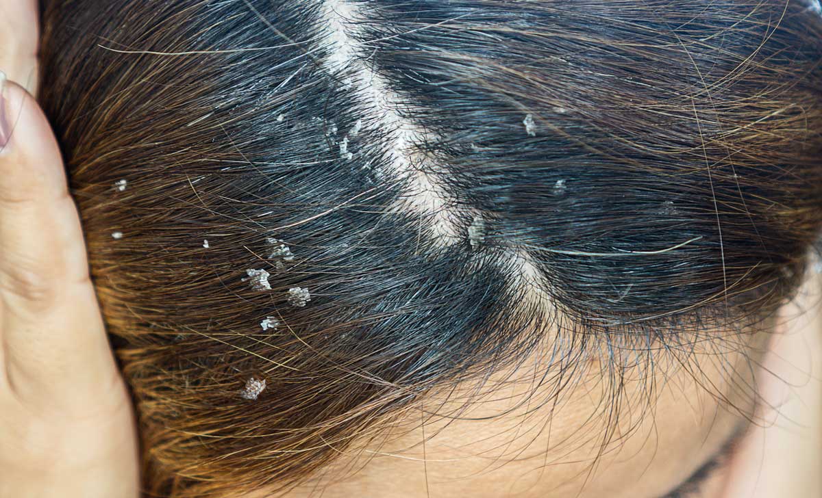 close up of woman's scalp with dandruff flakes