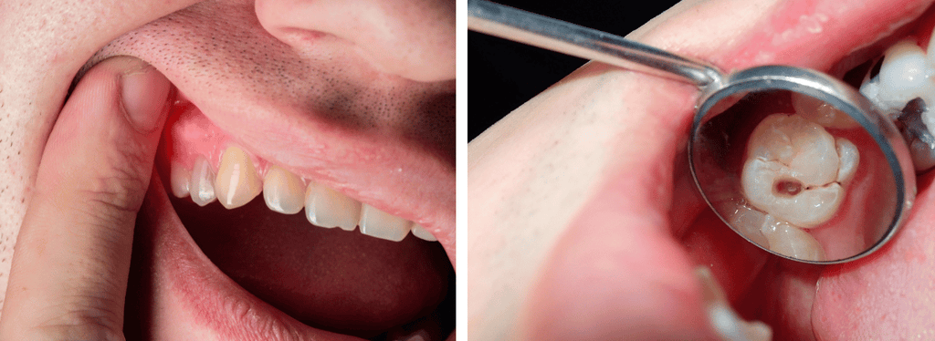 cavities-gum-disease