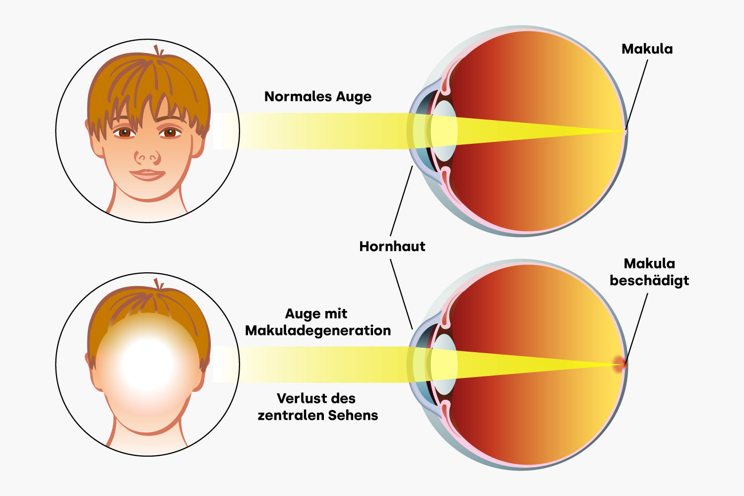 Normales Auge und Auge mit Makuladegeneration