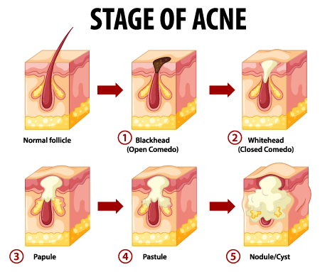 stages-of-acne_480x480
