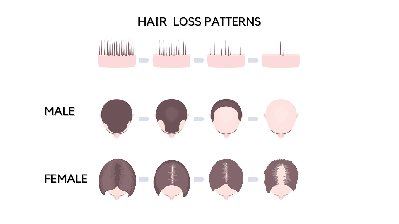 hairloss patterns
