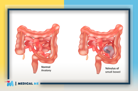 Effective Tips For Chronic Constipation Treatment