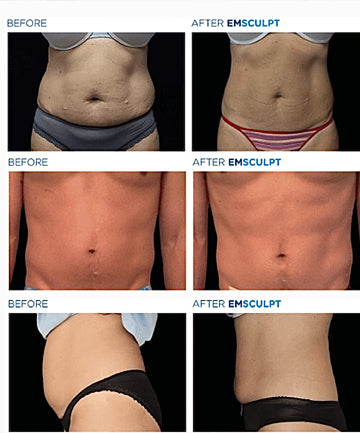 What is EMSculpt? Non-Surgical Body-Sculpting and Muscle Toning