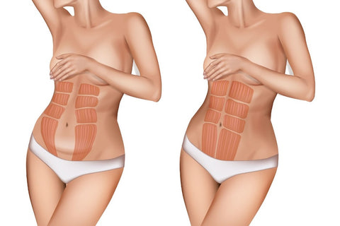 3D model showing the different areas where a diastasis can occur