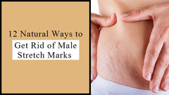 12 Natural Ways to Get Rid of Male Stretch Marks 