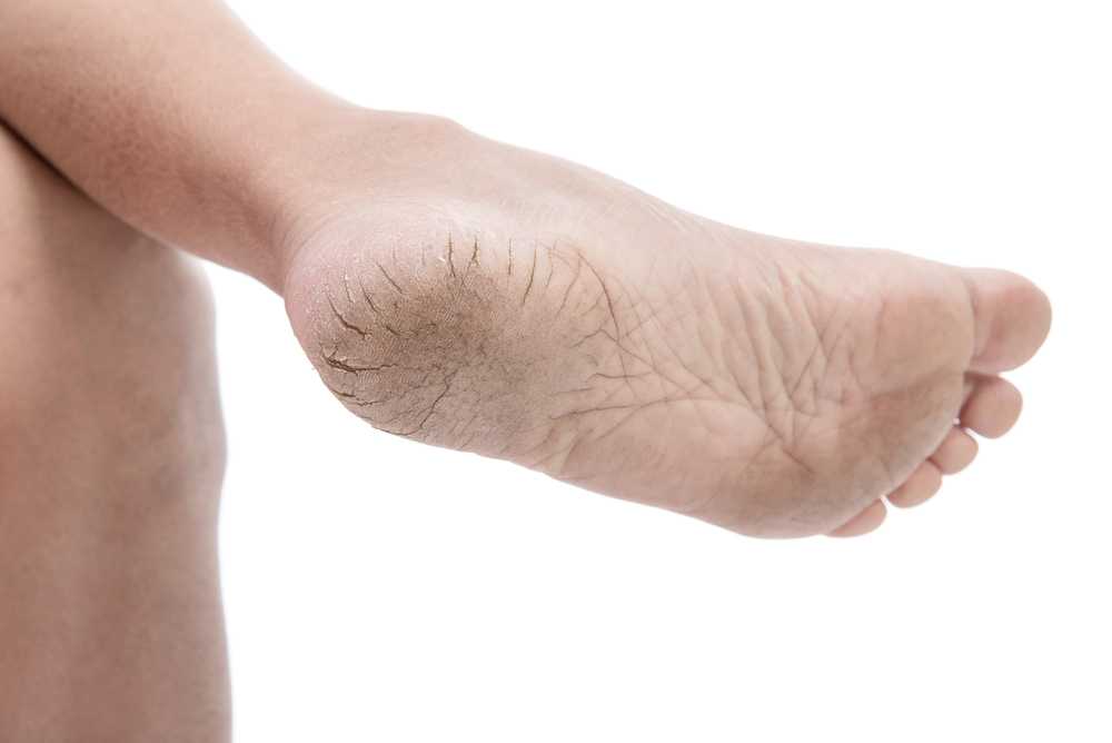 Seratopical Revolution Cracked Heel Souffle - Best Moisturizer to Improve  Dry Heels & Rough Skin - Sera Labs