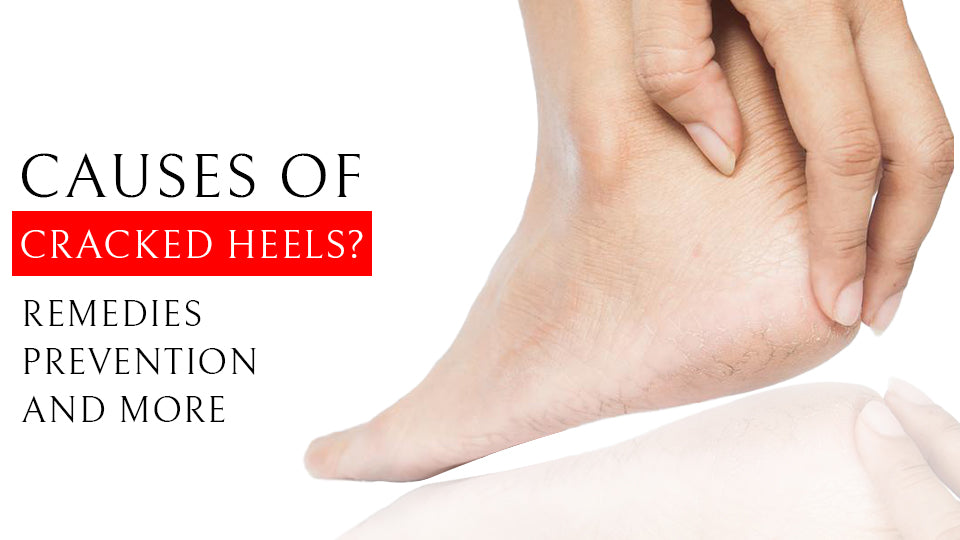 causes of cracked heels Remedies prevention and more