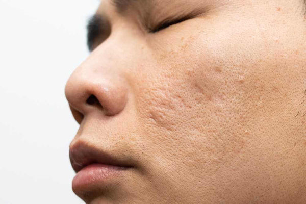 Facial Hyperpigmentation