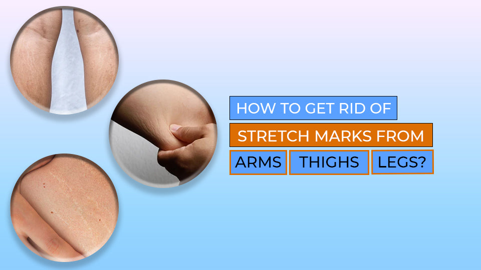How To Get Rid OF Stretch Marks From Arms, Thighs, Legs