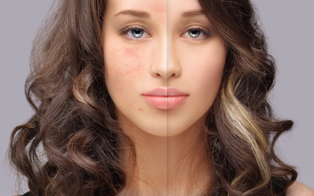 Fight Hyper Pigmentation - Vince