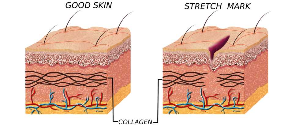 Stretch Marks Effects on Skin Layers