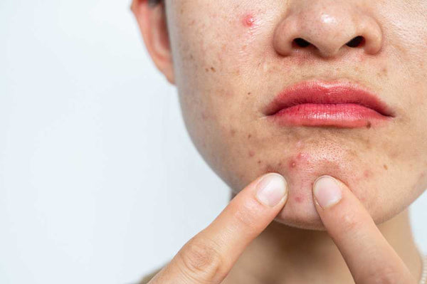 Skin Inflamation Make Skin Hyperpigmented 