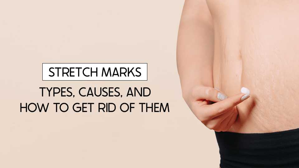 stretch marks types causes and how to get rid of them