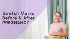 Stretch marks before and after pregnancy