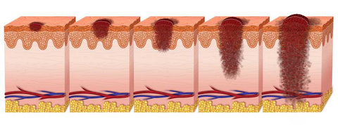 skin bristles creating cancer cells