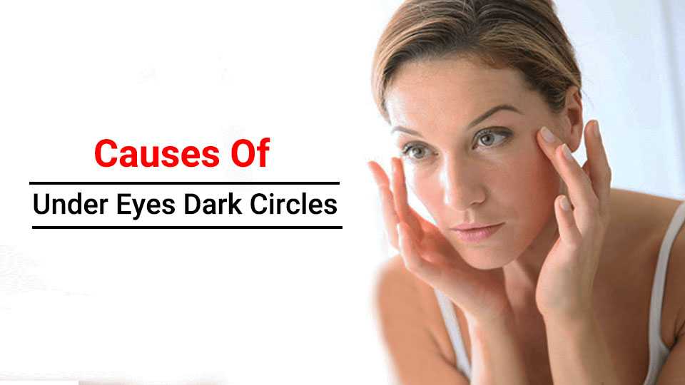 causes of under eye dark circles