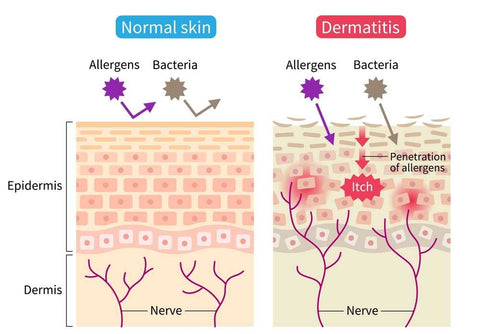 causes of eczema skin problem 