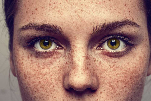 Freckle Skin dark spots 