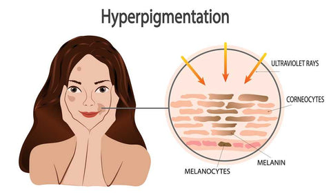 Hyperpigmented Skin