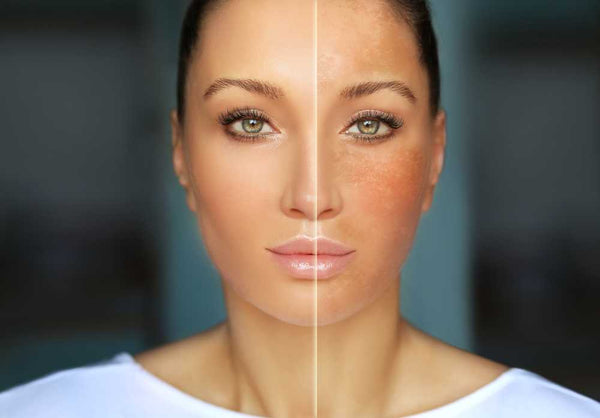 Hyperpigmentation on Face