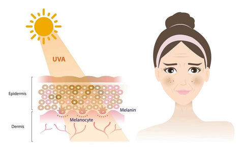 causes of Freckle Skin _ Vince 