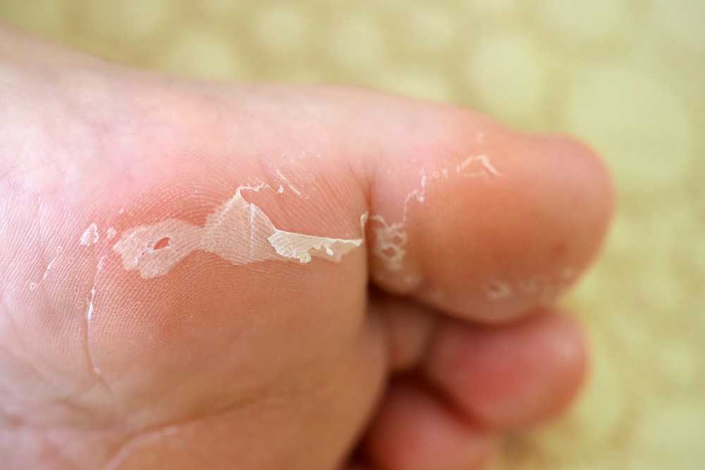 dead foot skin