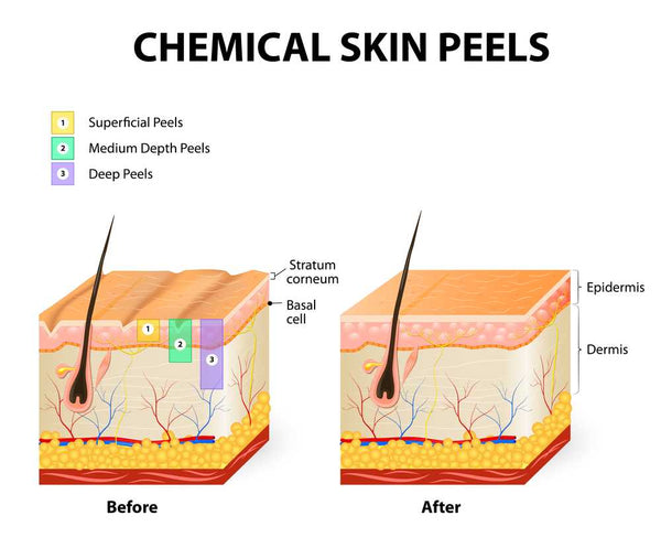 Chemical peel skin