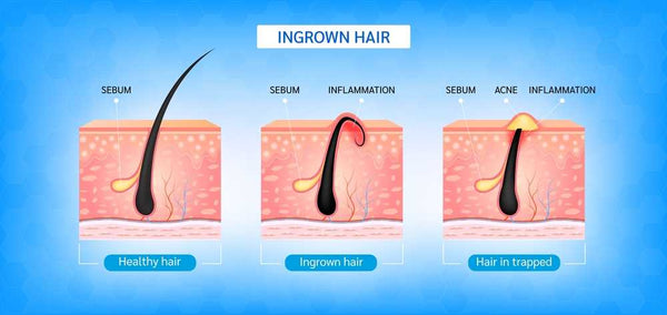Solution for Ingrow Hair problem - Vince Care