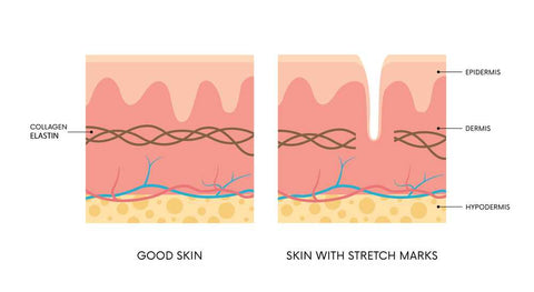 stretch marks skin layers