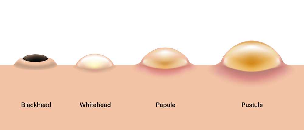 Types of Acne on skin
