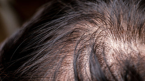 Nahaufnahme der Kopfhaut und des Haares einer Person, die deutlich dünner werdendes Haar zeigt, wobei die Kopfhaut durch die lichter werdenden Haare sichtbar ist.