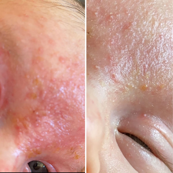Before and After Baby skin curing eczema 