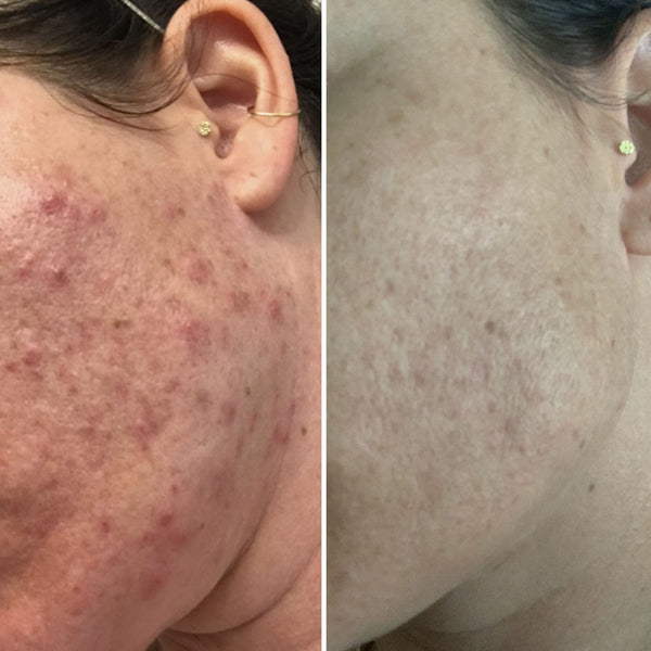 Before and After reducing acne and acne scars