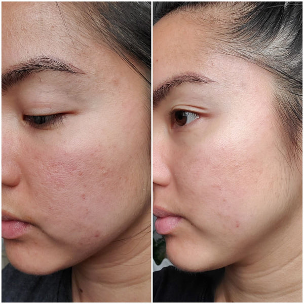 Before and after reducing redness in skin