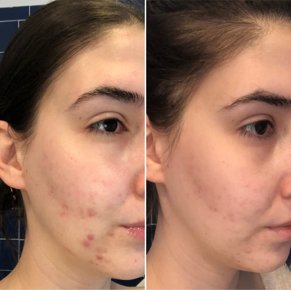 Before and After reducing acne and acne scars clean skin
