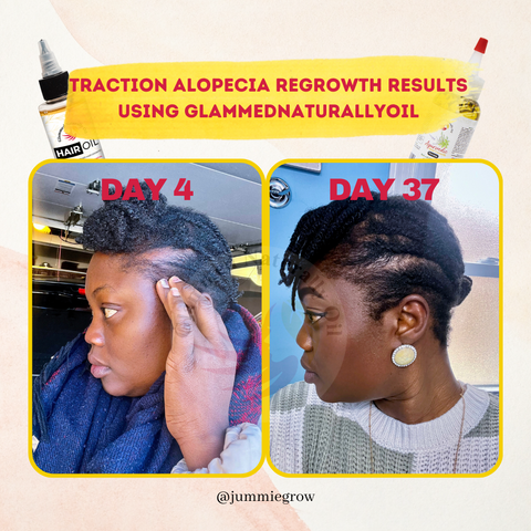 Traction alopecia before and after