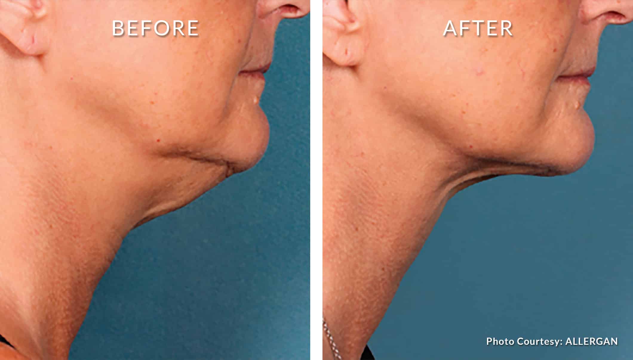 KYBELLA® for double chin