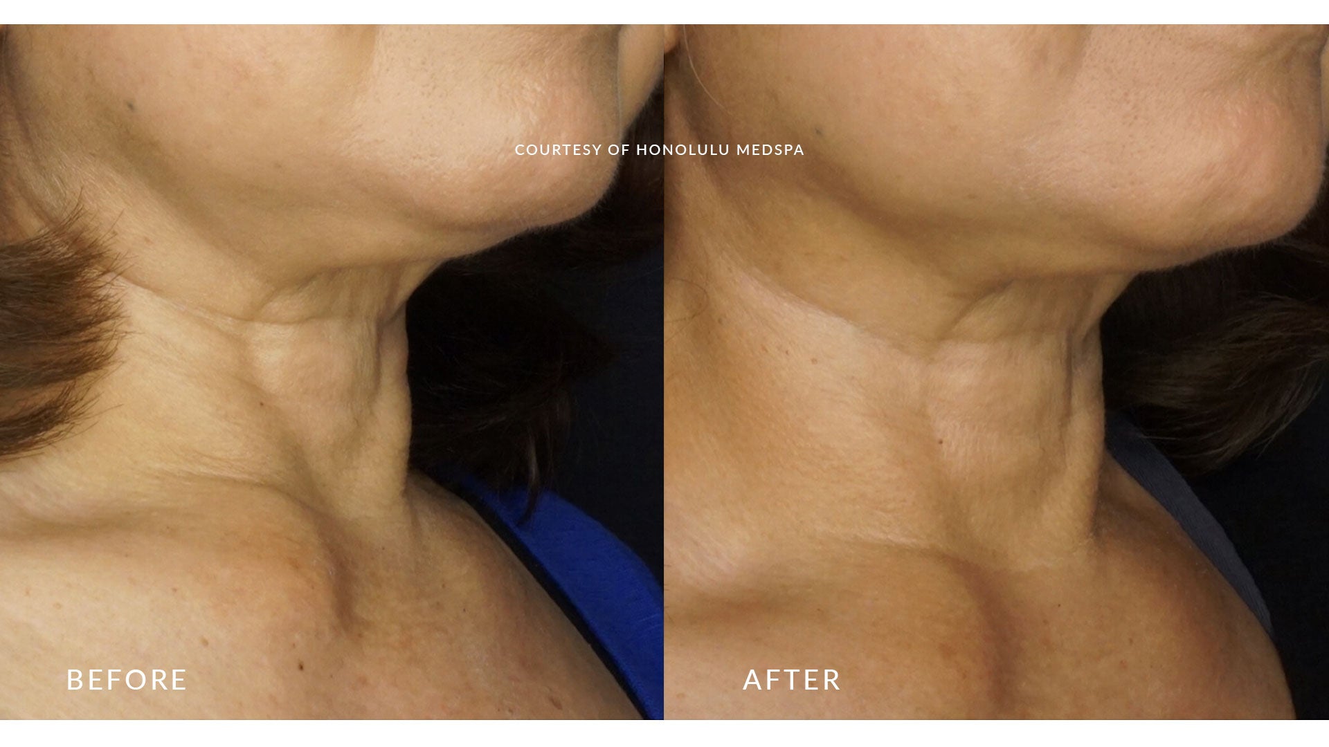 fotona 4d laser vs ultherapy