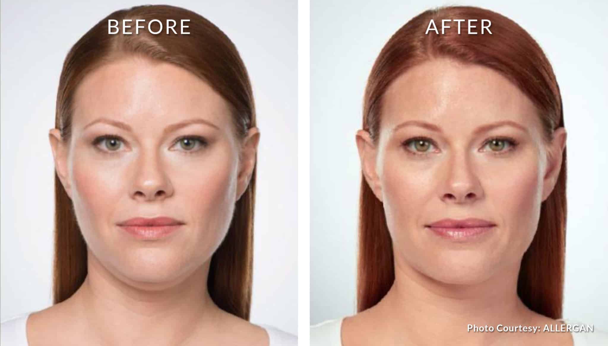 KYBELLA® for double chin