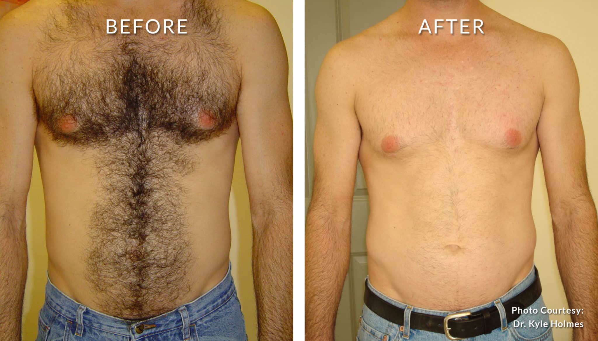 как удалить волосы на груди мужчин фото 61