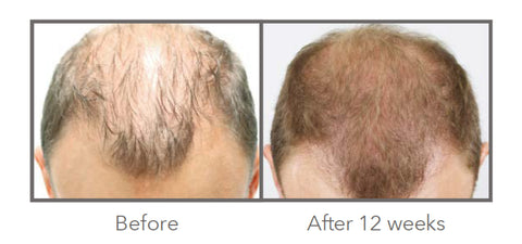 AnteAGE Home Hair System Before After 2