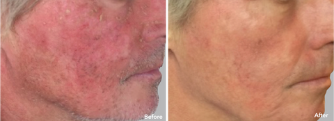 AnteAGE MD® Serum Before After